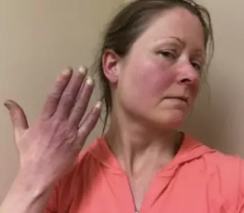 Acrocyanose (mains et visage) chez une patiente ayant un syndrome de tachycardie orthostatique posturale