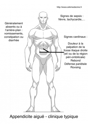 Appendicite aiguë - sémiologie clinique typique