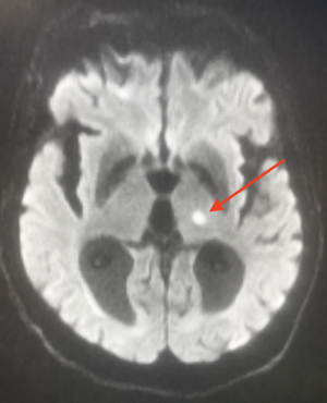 IRM - Diffusion - Infarctus lacunaire récent thalamique gauche