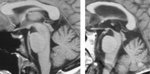 Izquierda: RM cerebral normal. Derecha: RM cerebral que muestra un "signo del colibrí" (atrofia mesencefálica y agrandamiento del cuarto ventrículo) característico de la parálisis supranuclear progresiva.